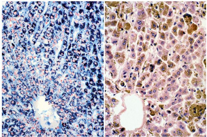Liver disease