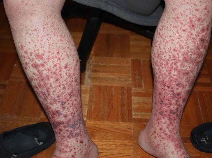 idiopathic thrombocytopenic purpura