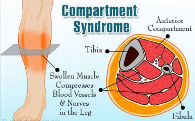 Symptoms of Compartment syndrome