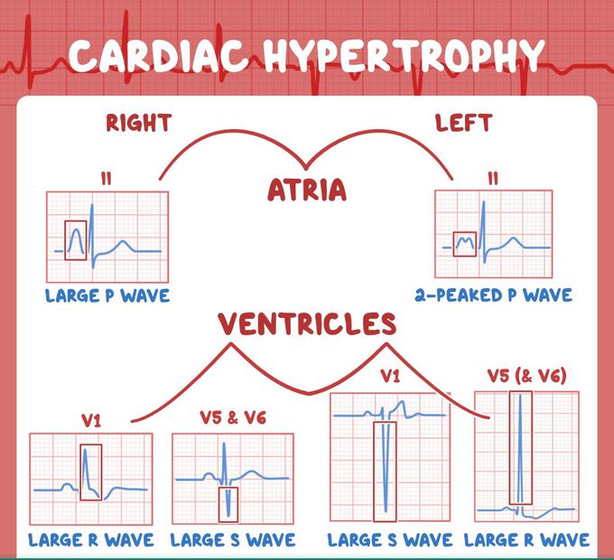 EKG Markers for Cardiac hypertrophy in each chambers