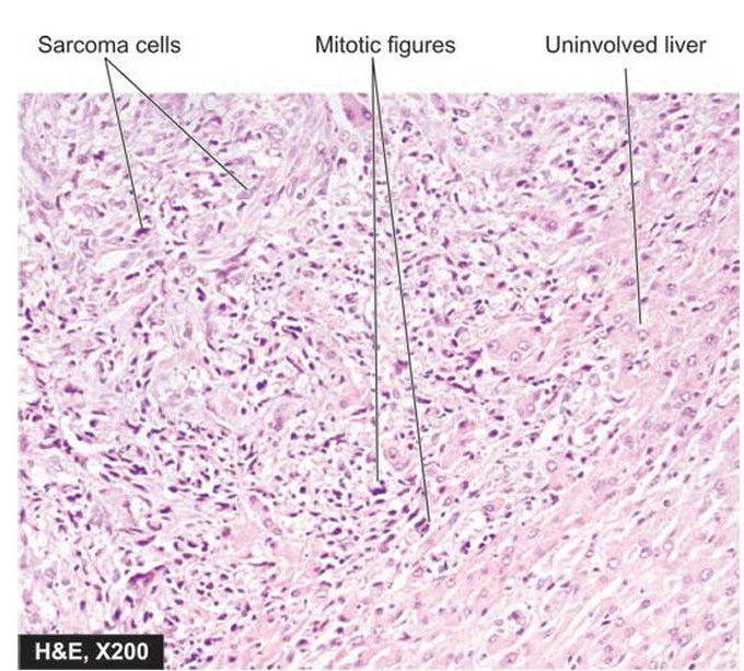 Metastasis in liver