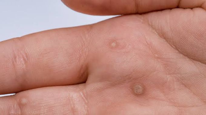 Can warts be contagious?