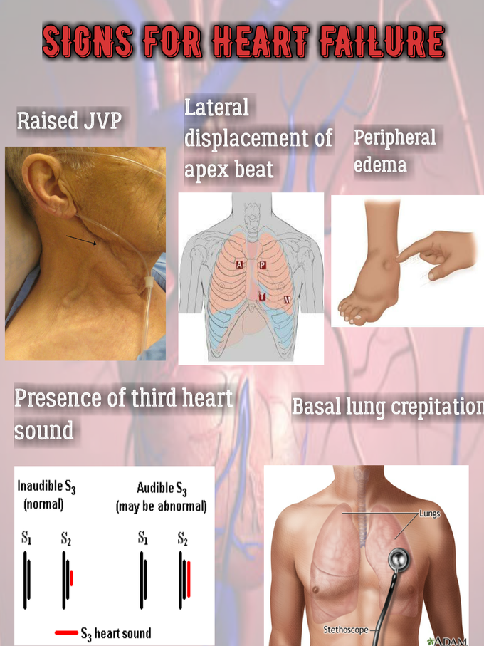 Signs specific for HEART FAILURE - MEDizzy