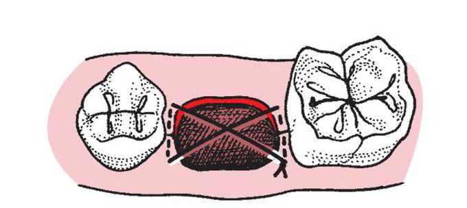 Figure of eight suture