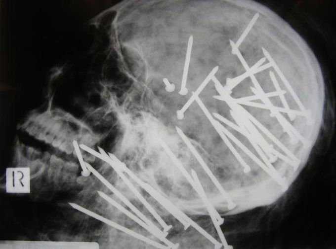 Nail gun murder X-Ray