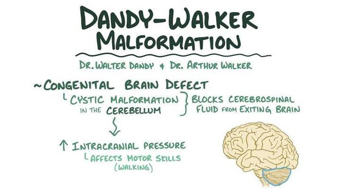 Dandy walker malformation