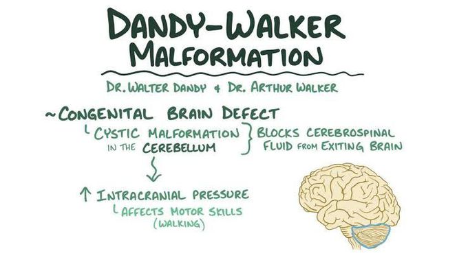 Dandy walker malformation - MEDizzy