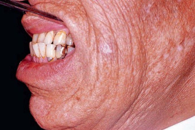 Acromegaly (showing prognathic mandible)
