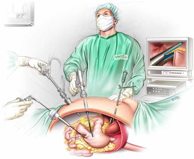 Surgery of sleeve gastrectomy