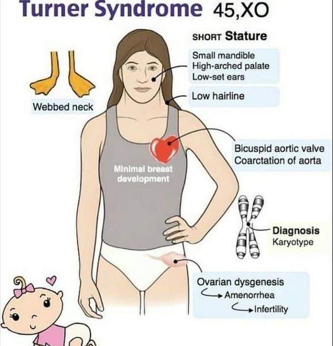 turner syndrome patient