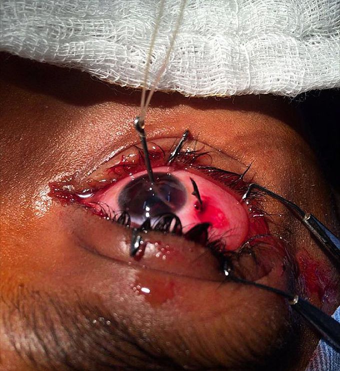 Eye injury sustained while fishing from a fishing hook!