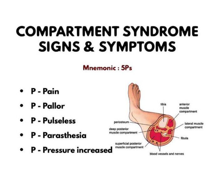 Compartment Syndrome