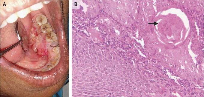 Squamous-Cell Carcinoma of the Mouth