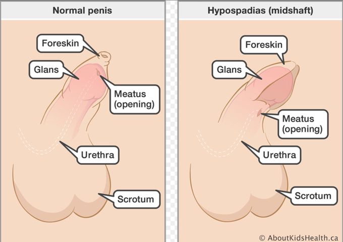 Hypospadias