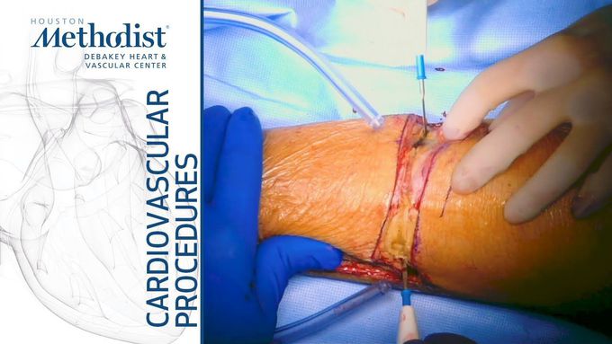 Below Knee Amputation In the OT