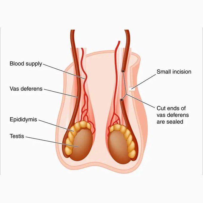 Vasectomy Requests Increase