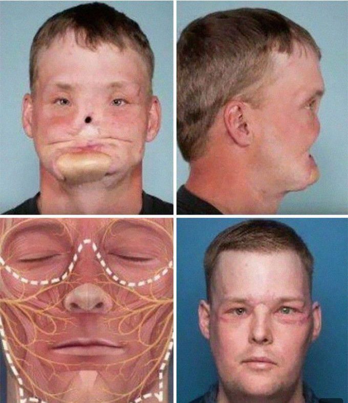 An Incredible Face Transplantation