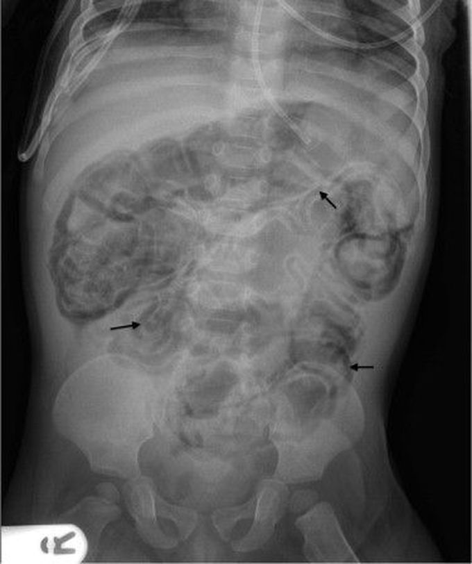 Pneumatosis Intestinalis