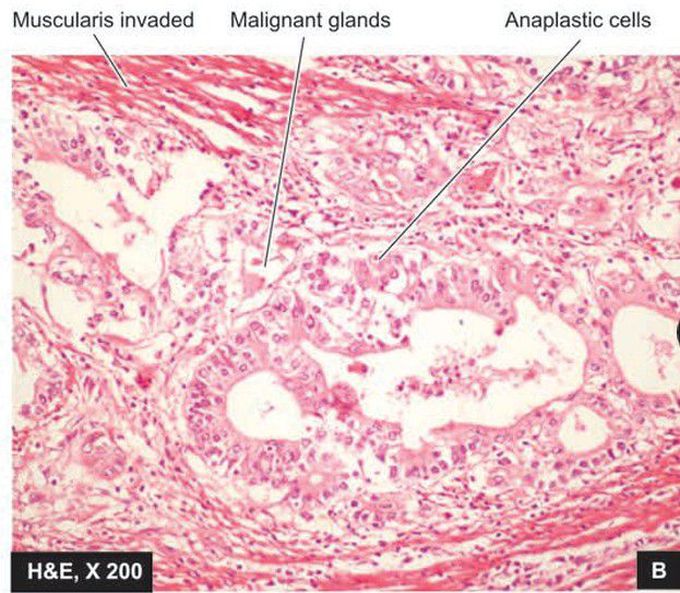 Ulcerative carcinoma stomach