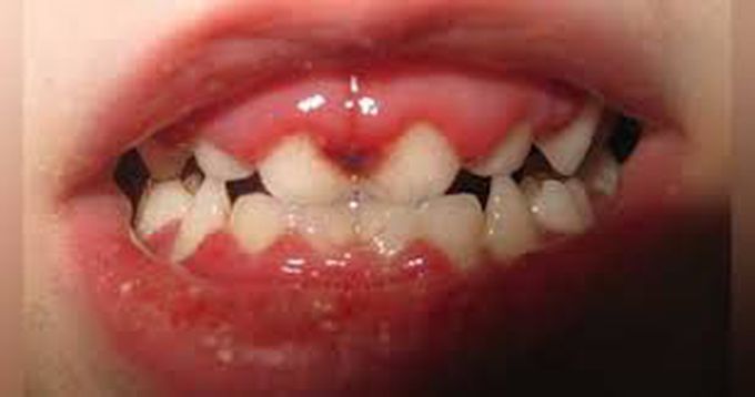 Gingivostomatitis