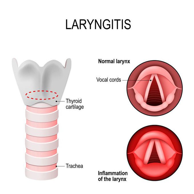 Cause of Laryngitis