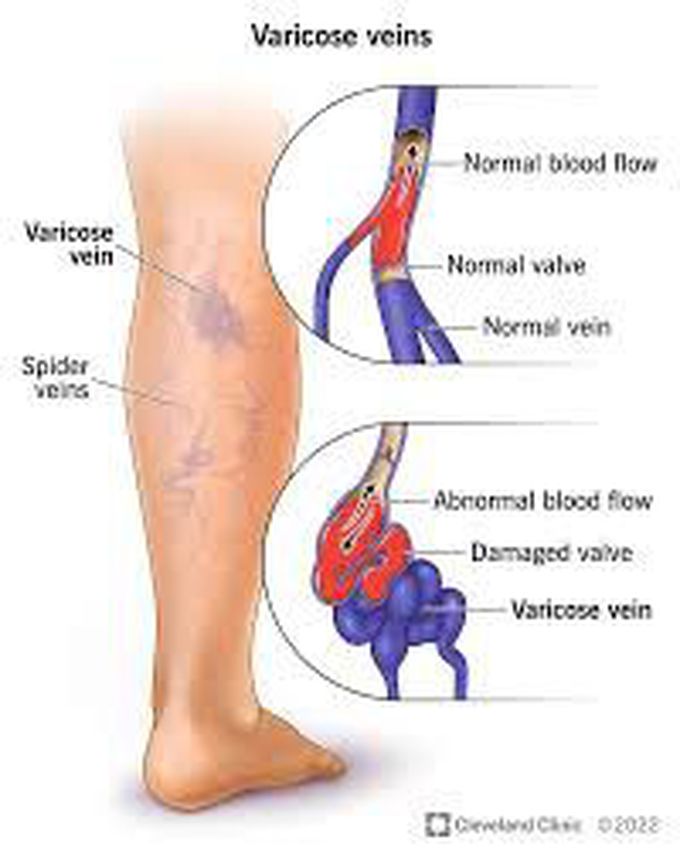 Symptoms of varicose veins