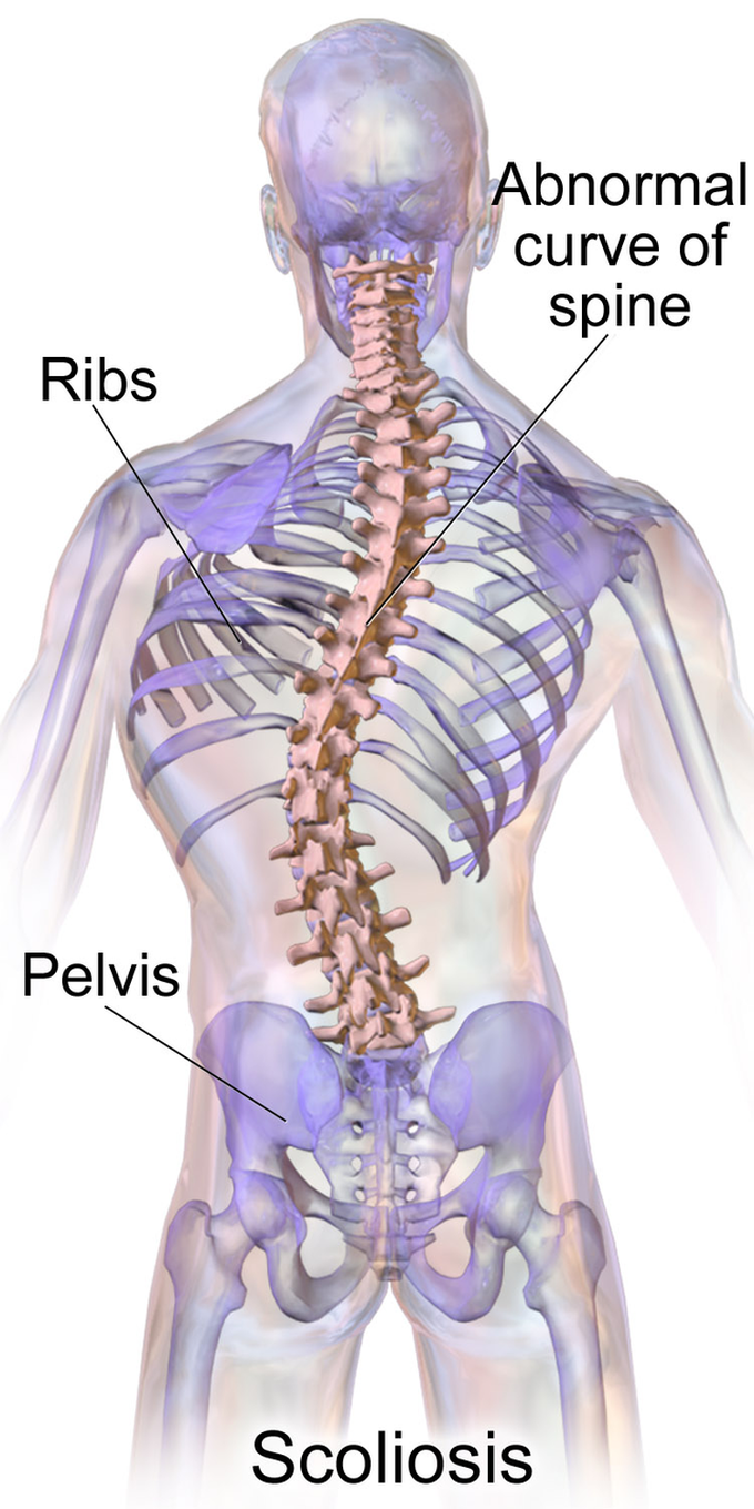 Treatment of scoliosis