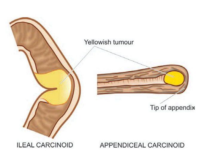 Carcinoid tumour.