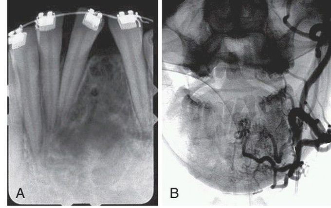 Intrabony Arteriovenous Malformation