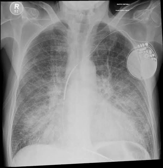 Pulmonary congestion