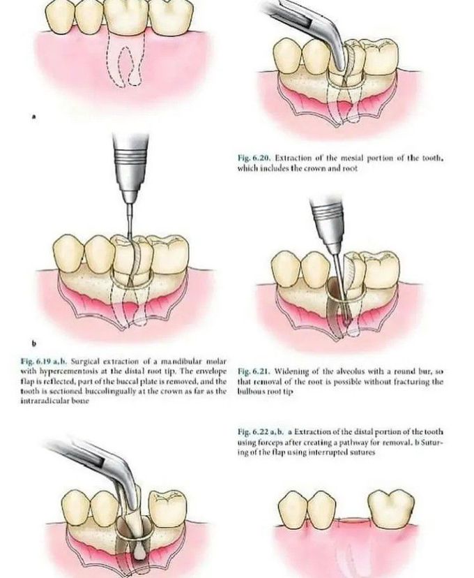 Sectioning and extraction of a tooth having hypercementosis