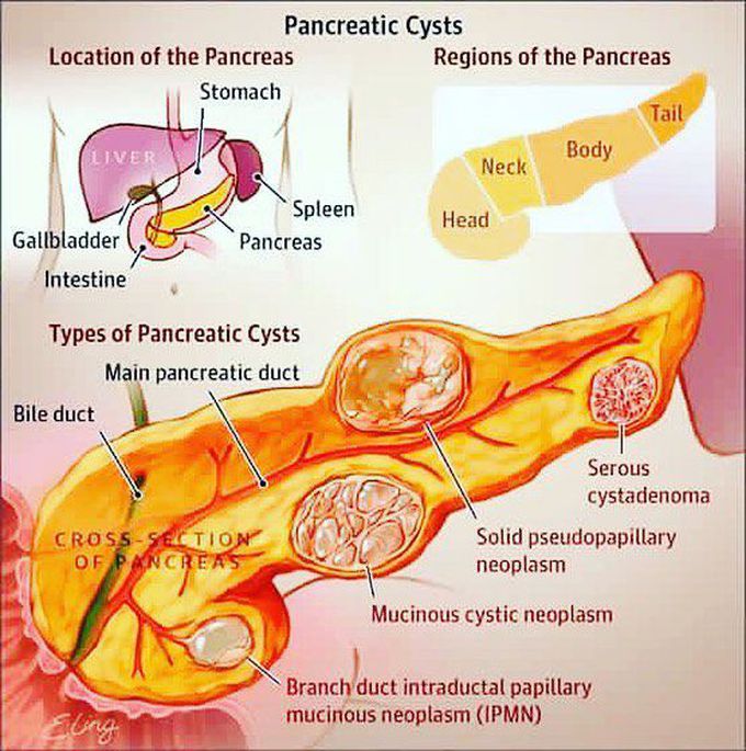 Pancreatic cysts