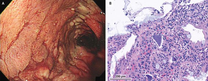 Calcium Polystyrene Sulfonate–Related Colonic Necrosis