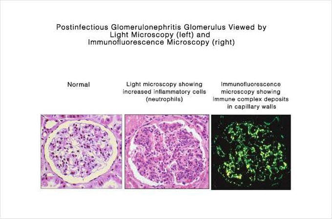 Post streptococcus Glomerulonephritis