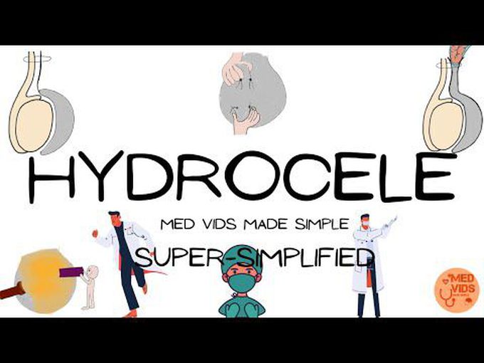 Hydrocele