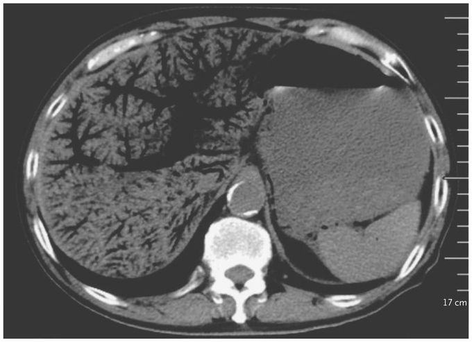 Portal Venous Gas