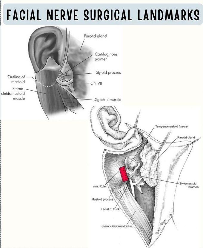 Facial Nerve- Surgical Landmarks