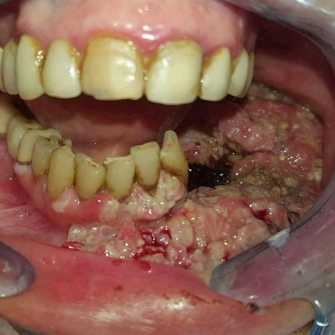 Cancer of Oral Cavity