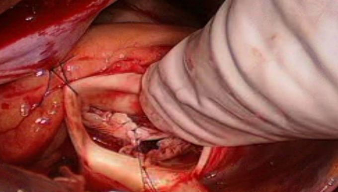 Aortic Valve Repair