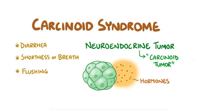 Carcinoid syndrome and carcinoid tumours