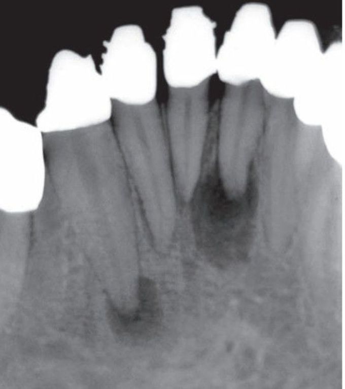 Periapical granuloma PA xray