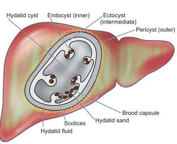 Hydatid cyst in the liver.