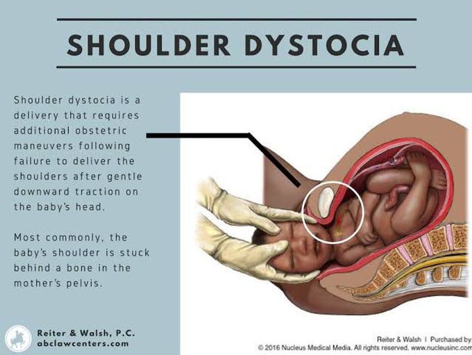 Signs of shoulder dystocia