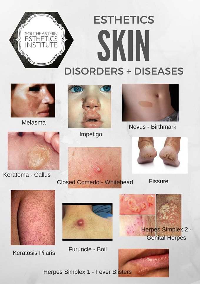 Skin disease
