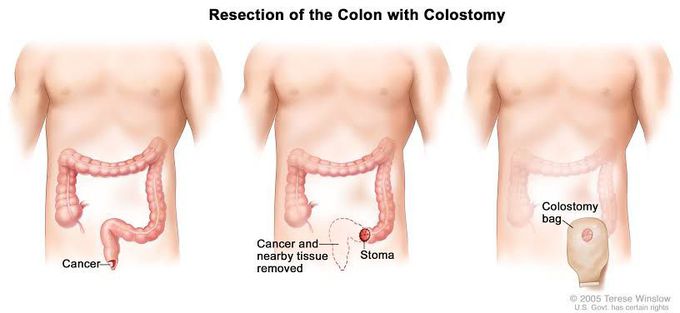 Abdominoperineal resection