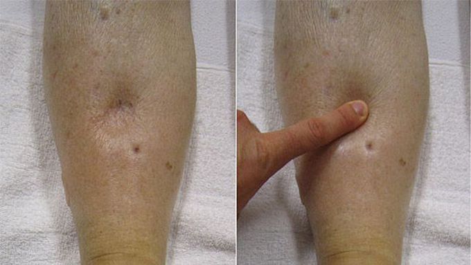 Pitting edema