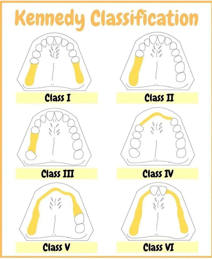 Kennedy Classification