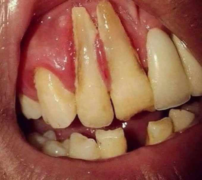 Gingival recession