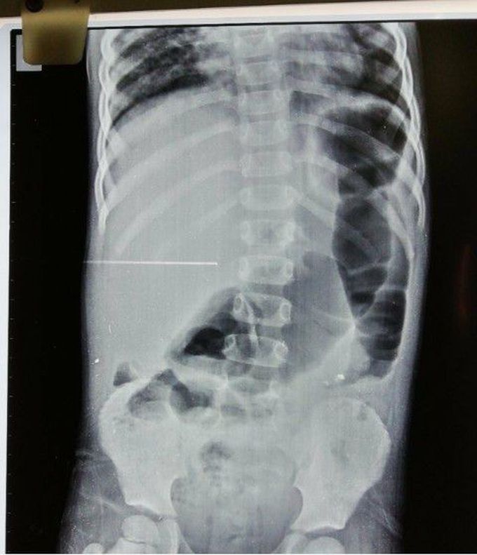 Abodmen X-RAY