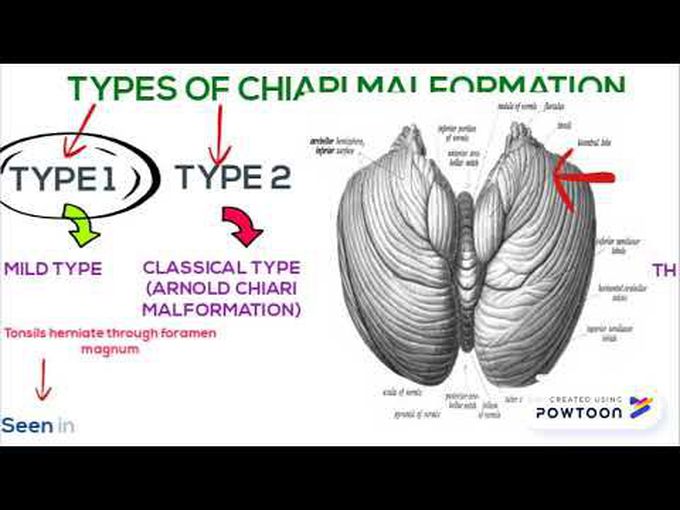 Posterior Fossa Anomalies: Chiari Malformations